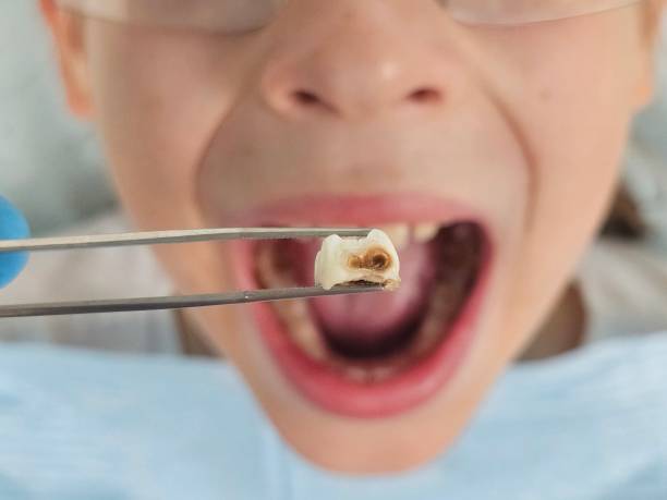 Best Emergency Tooth Extraction in El Jon, CA